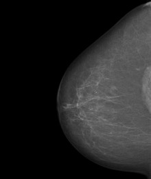 Mammographie: normaler Befund