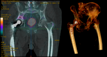 SPECT-CT Hüftprothesenlockerung