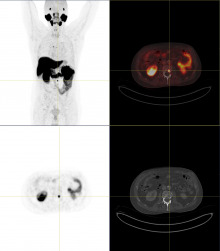 Knochenmetastase Prostatakarzinom im PSMA PET-CT