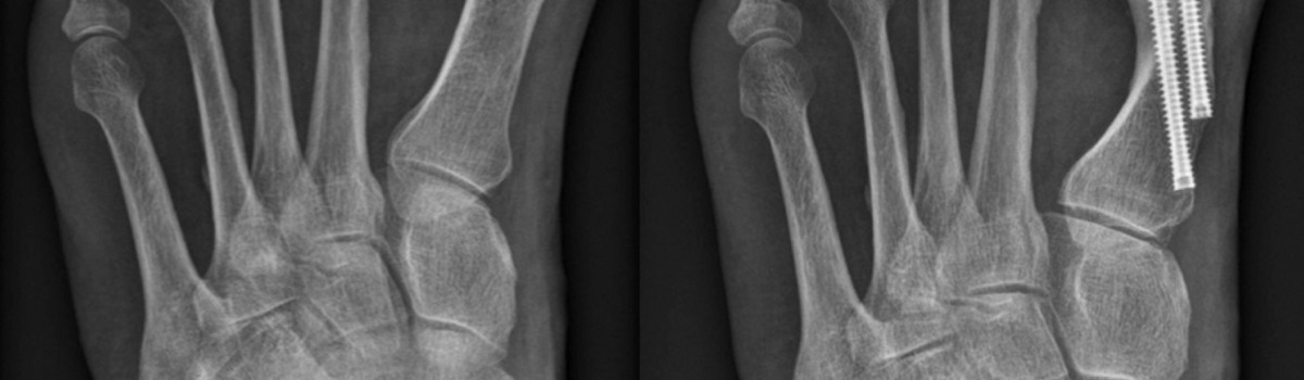 Röntgenbild des linken Fusses vor und nach minimalinvasiver Hallux valgus Korrektur in MICA-Technik