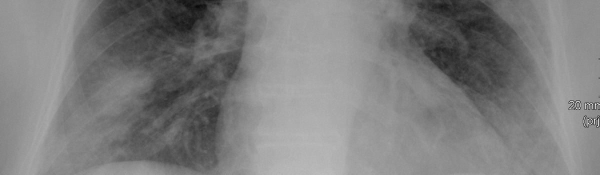 Röntgenbild Forschung Respiratorisch