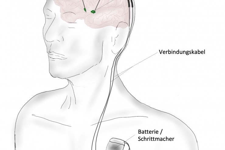 Tiefe Hirnstimulation / Deep Brain Stimulation (DBS)