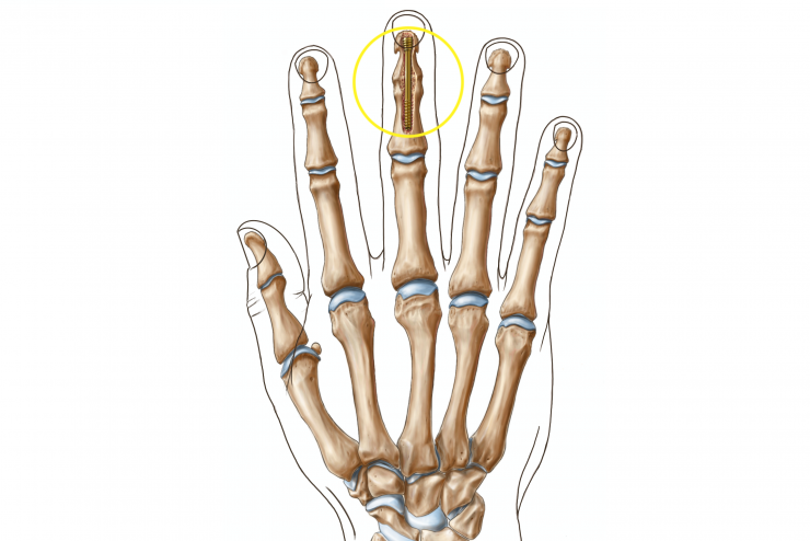 Arthrodese Fingerendgelenk
