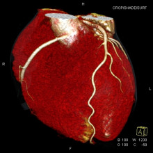 CT-Untersuchung Herz