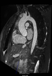 MRT-Untersuchung der Aorta