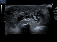 Ultraschallaufnahme Bursitis olecrani
