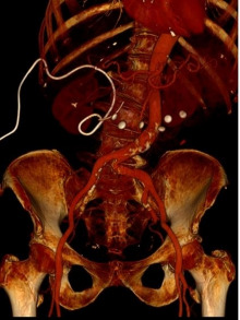 CT-Angiographie der Bauchaorta