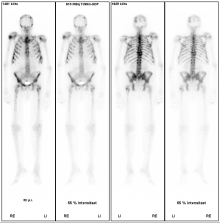 Skelettszintigraphie Metastasen