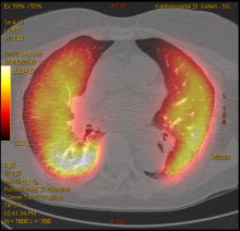 SPECT-CT Lungenperfusion