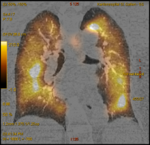 SPECT-CT Lungenventilation