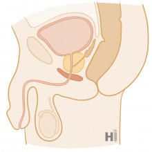 Prostatahyperplasie1