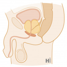 Prostatahyperplasie2