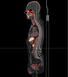 Knochenmetastasen Prostatakarzinom im PSMA PET/CT (2)