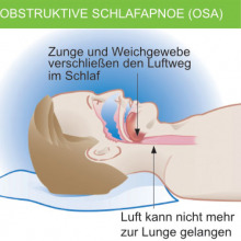 Grafik Atmung bei obstruktiver Schlaf-Apnoe